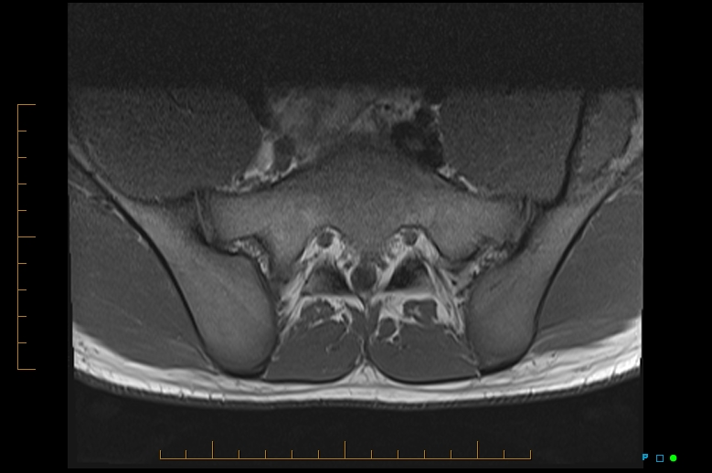 Figure 3 for case Fibrous dysplasia
